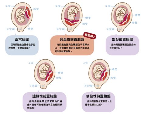 前置胎盤原因|前置胎盤